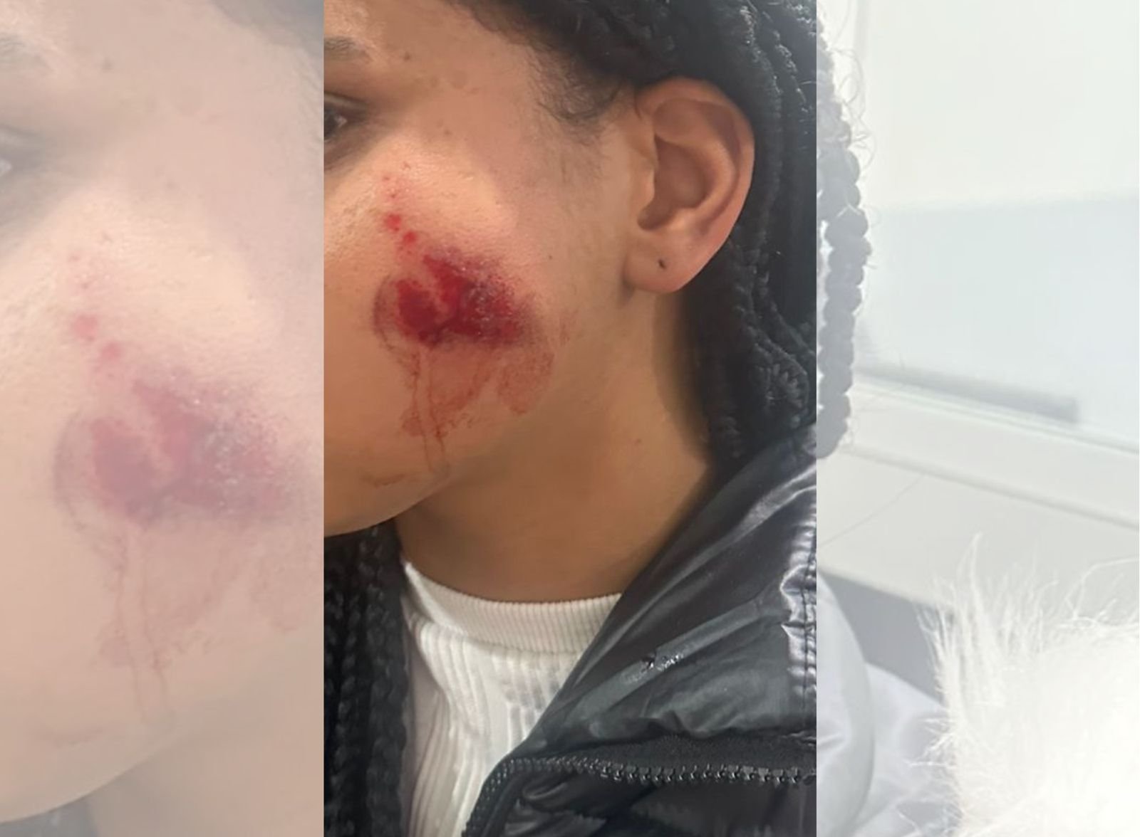Menina de 12 anos é ferida por bala de borracha em operação policial